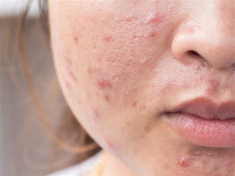How To Get Rid Of Cystic Acne Treatment According To Dermatologists