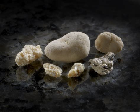Stones can cause soft drink. Large Kidney Stones - Treatments for Kidney Stones ...
