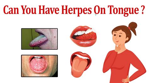 Can You Have Herpes On Tongue Tongue Herpes Natural Tongue Herpes