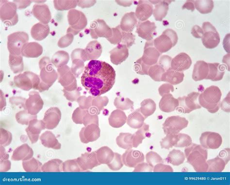 Eosinophil Cell Stock Photo Image Of Abnormal Pathology 99629480