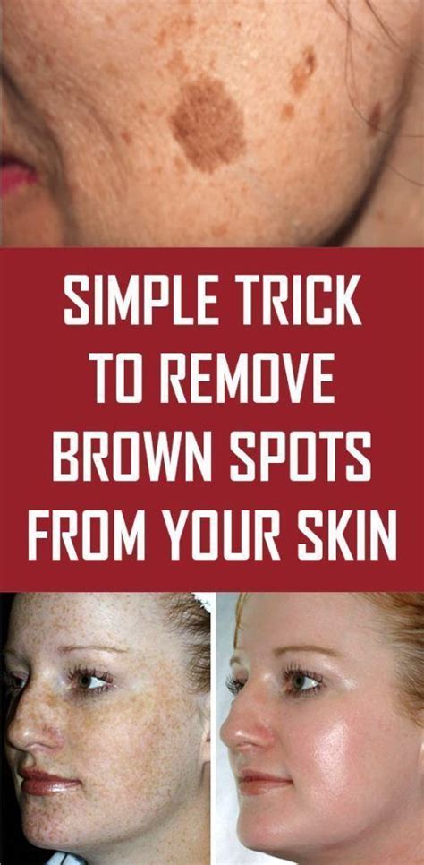 Simple Trick To Remove Brown Spots From Your Skin Brown Spots On