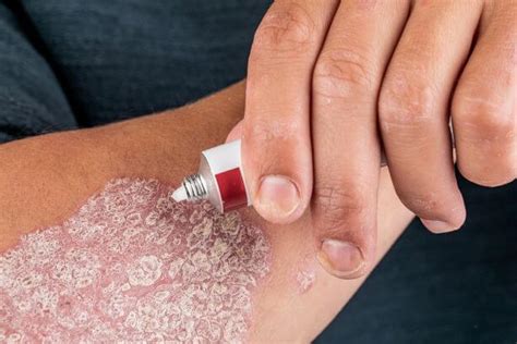 How To Treat Psoriasis Explained By Dermatologist Blog