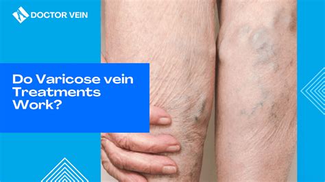 Varicose Eczema Itchy Rash Near Varicose Veins Doctor Vein