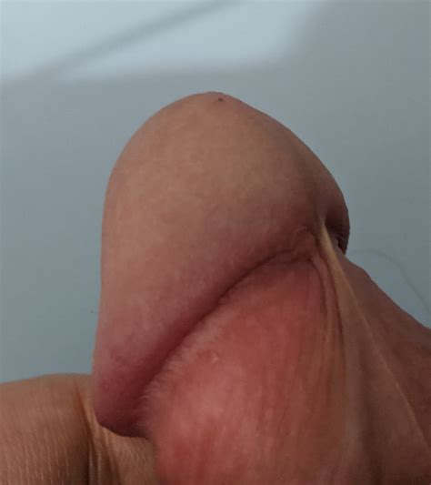 Frenulum Breve Or Phimosis Please Help Images Attached Penis