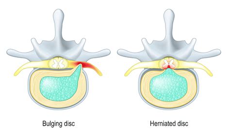 Key Differences Between A Herniated And Bulging Disc A Sufferer In