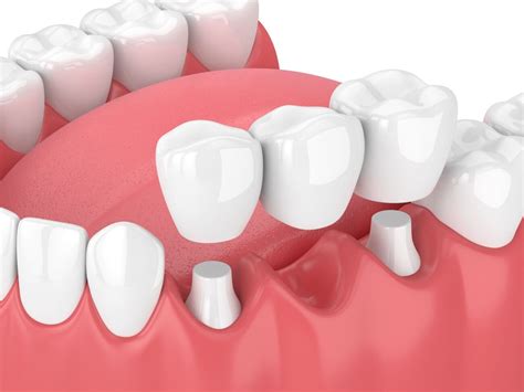 Dental Bridges For Missing Teeth Dentist In Towson Md