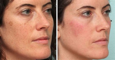 Face Treatment Ipl Doctor Heck