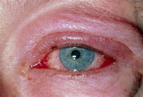 Allergic Conjunctivitis Stock Image M1550133 Science Photo Library