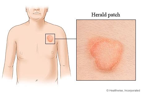 Herald Patch In Pityriasis Rosea Video Image