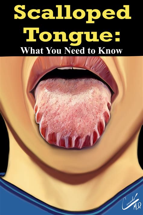 Scalloped Tongue Why What Causes It Things You Need To Know Tongue