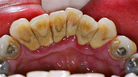 Plaque Calcification Teeth Teeth Bonding