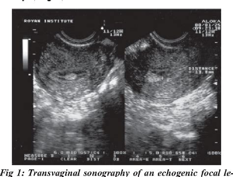 Polyps Endometrial Multiple Ultrasound Ultrasound Sonography Sonography