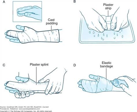 Reduction And Splinting Techniques Obgyn Key