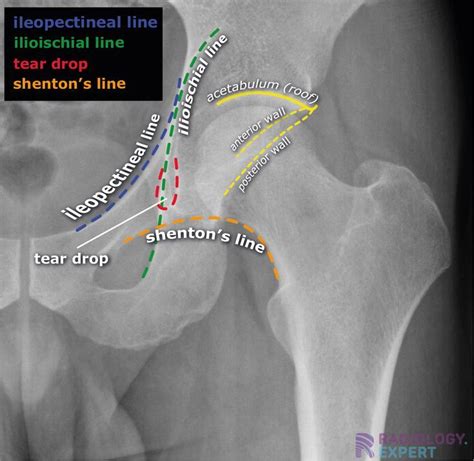 Helpful Lines On A Hip X Ray To Distinguish Normal Anatomy From
