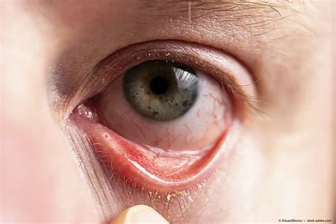 Allergic Conjunctivitis Axis Eye Clinic