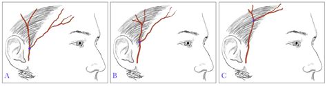 Temporal Artery Biopsy Article
