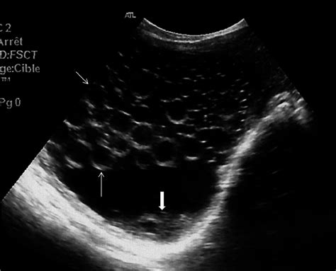 Ultrasound Image Showing Typical Multivesicular Hydatid Cyst In The