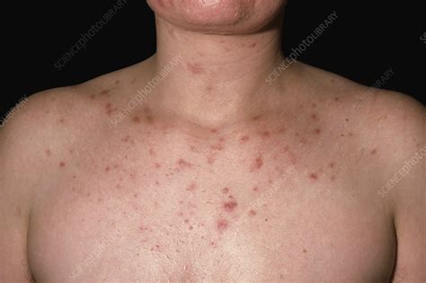 Acne On The Chest Stock Image C0482927 Science Photo Library