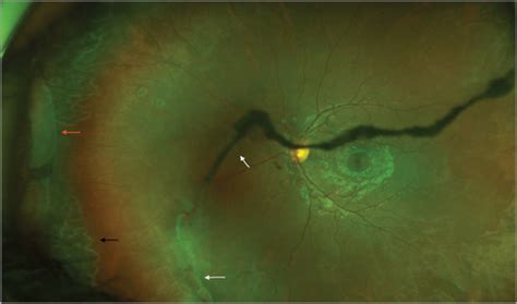 Large Traumatic Retinal Dialysis Associated With Prominent Vitreous