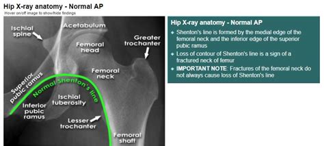 Hip X Ray Anatomy Normal Ap Shentons Line Is Formed Grepmed