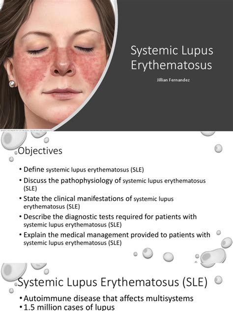 Systemic Lupus Erythematosus Pdf Systemic Lupus Erythematosus