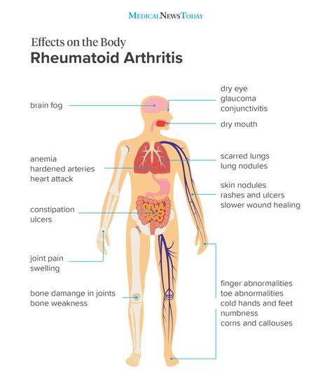 Arthritis is a common condition that causes pain and inflammation in a joint. Rheumatoid arthritis (RA): Signs and symptoms