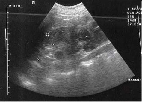 Cystic Nephroma A Case Report And Review Of The Literature Cases