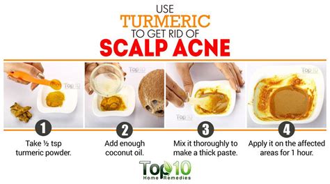How To Get Rid Of Scalp Acne Top 10 Home Remedies