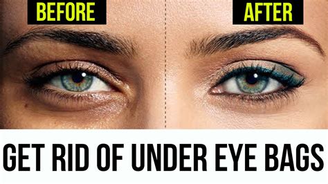 How To Get Rid Of Eye Bags 37 Ways Healing Picks
