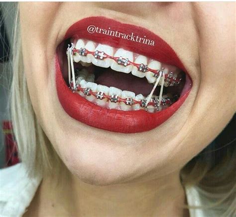 Different Color Braces For Teeth Warehouse Of Ideas