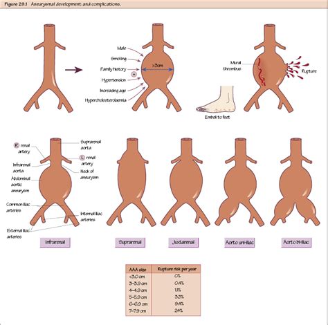 Abdominal Aortic Aneurysm I Overview Thoracic Key