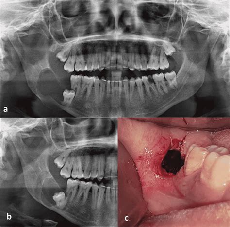 Dentigerous Cyst Clinical Features