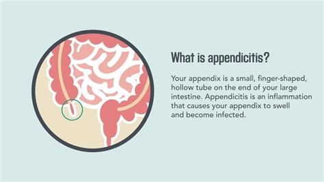 Appendicitis Symptoms Causes Diagnosis Treatment