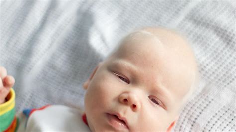 Albinizm przyczyny objawy skutki Czy bielactwo wrodzone można leczyć