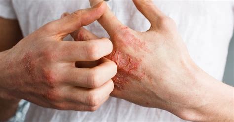 Eczema Definition Causes And Treatment