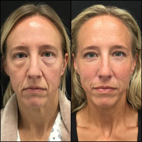 lower blepharoplasty before and after photos flora levin md