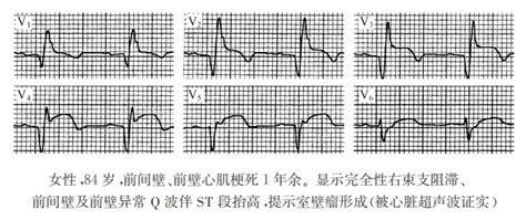 再灌注治疗对急性心肌梗死转归的影响 - 心电图学 - 天山医学院