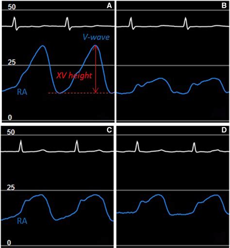 Reduction In Right Atrial Pressures Is Associated With Hemodynamic
