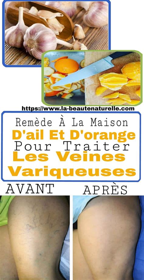 Remède À La Maison D'ail Et D'orange Pour Traiter Les Veines Variqueuses #orange#ail#veines ...