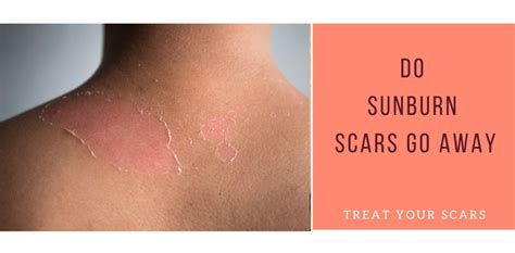 Do Sunburn Scars Go Away Treat Your Scars