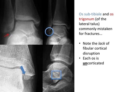 Ankle Fractures Questionimage Bank