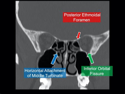 Normal Sinus Ct Annotated Image