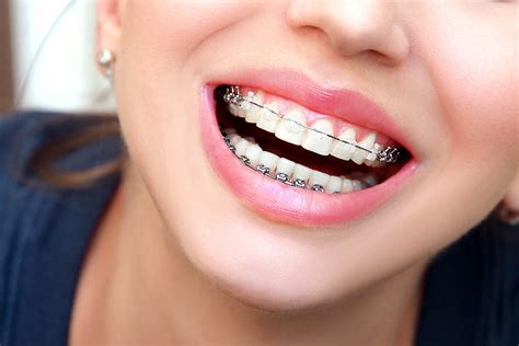 5 Signs You Need Dental Braces Again Orthodontics Texas