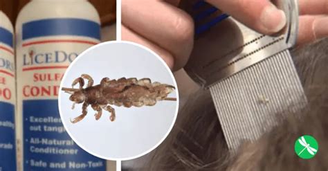 Super Lice Chemical Resistant Head Lice On The Rise