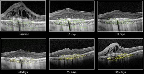 Choroidal Thickness At Different Times Baseline 15 30 60 90 And