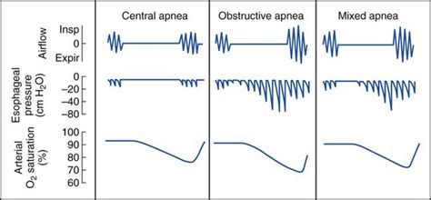 Sleep Apnea Thoracic Key