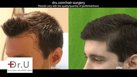 Average Cost Of Hair Transplant Surgery Mathilde Blalock