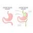 Duodenal Switch Complications  Bariatric Journal