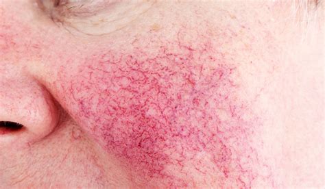 Skin Concerns Charlotte Skin And Laser