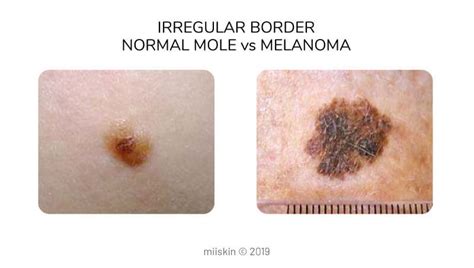 Melanoma Pictures Skin Melanomas Vs Non Cancerous Moles